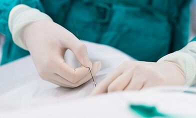 Diagnose von Krampfadern eines kleinen Beckens