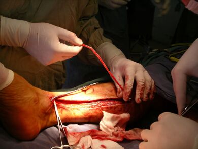 Venenchirurgie