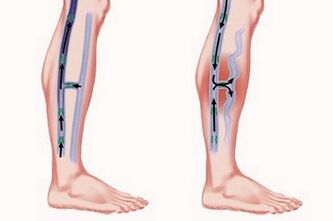 Mechanismus der Entstehung von Krampfadern
