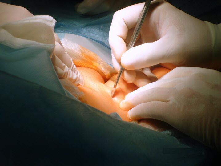 chirurgische Behandlung von Krampfadern an den Beinen bei Frauen