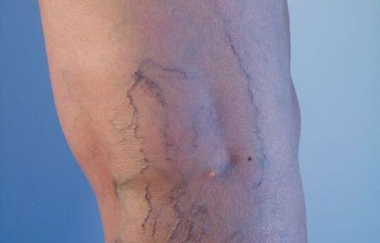 Krampfadern an den Beinen bei Frauen