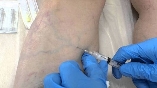 Sklerotherapie bei Krampfadern an den Beinen bei Frauen