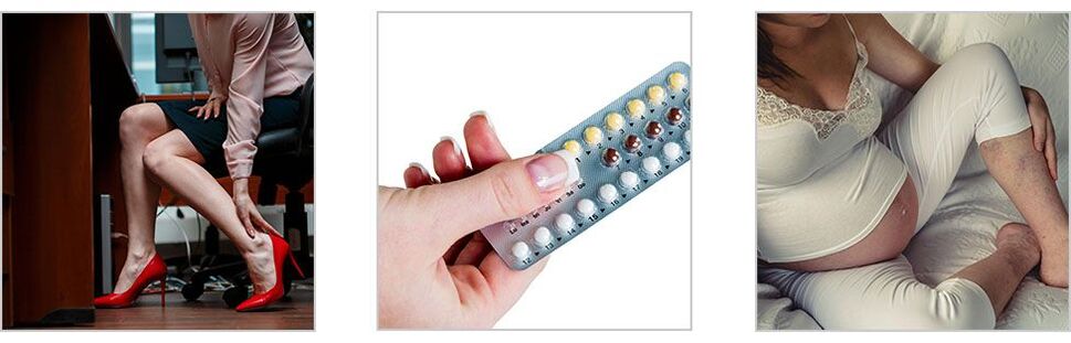 Ursachen für Krampfadern an den Beinen