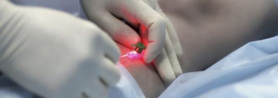 Entfernung einer Vene im Bein mittels Laserkoagulation